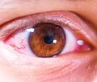 An Updated Overview of Inflammatory Dry Eye