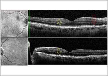 GA Case Compendium Simultaneous Development of Geographic Atrophy and Wet AMD in a Patient Lost to Follow up
