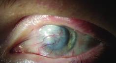 Where Do Specialty Contact Lenses Fit Into the Evolving Medical Optometry Practice