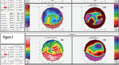 Pentacam CSP Software to Improve Efficiency and Efficacy of Complex Custom Scleral Lens Design