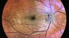 Optic Neuritis