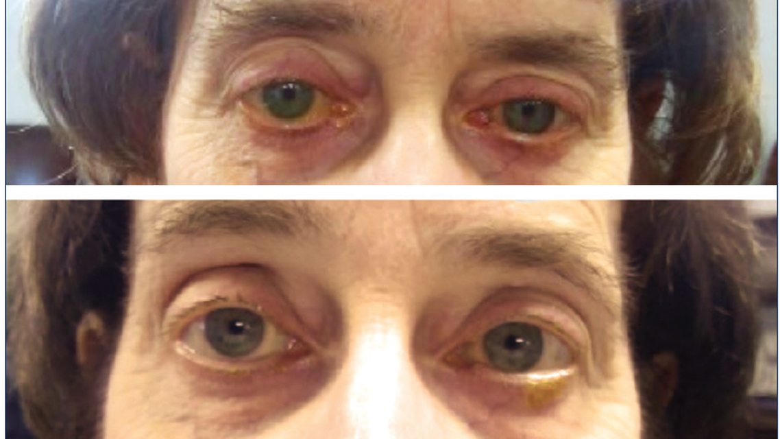 Did I Miss the MIGS Boat