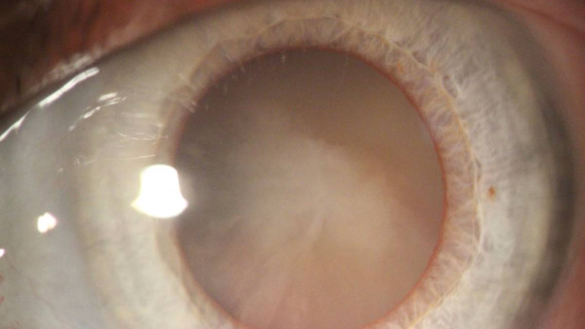 cataract