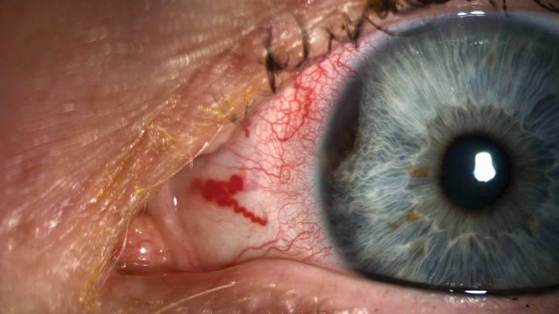 Uveal Melanoma