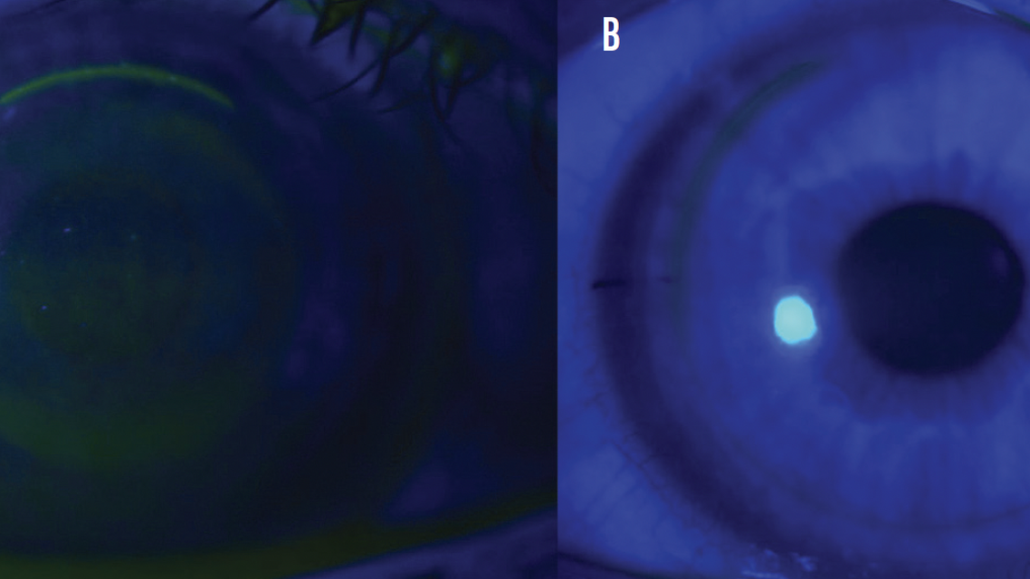 The Pros and Cons of LASIK vs SMILE