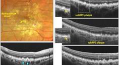 GA Case Compendium Identifying High Risk Biomarkers for Geographic Atrophy Development and Multimodal Imaging Strategies for