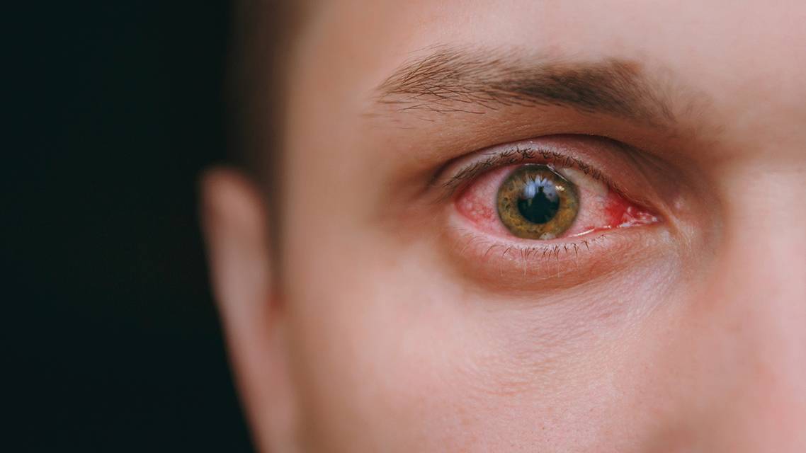 A Primer on Herpes Simplex Keratitis