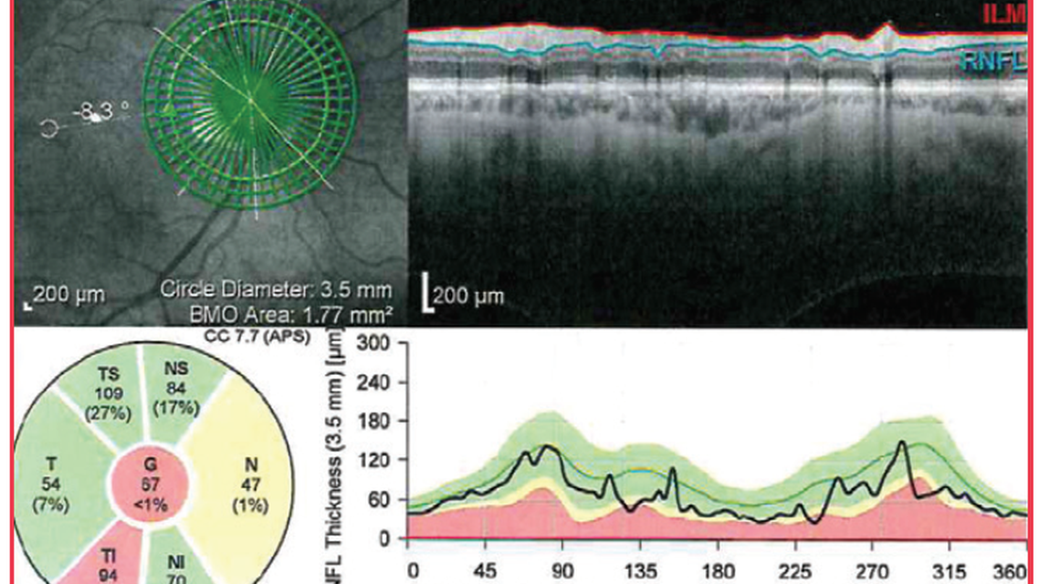 OMNI in Standalone Pseudophakic Patients