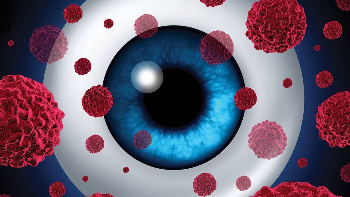 Case Report Ocular Melanoma
