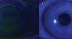 The Pros and Cons of LASIK vs SMILE