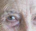 A Noninvasive Alternative to Cataract Surgery
