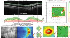 OCT imaging of glaucoma