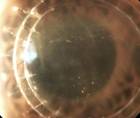 Corneal Graft Rejection Versus Failure