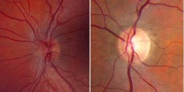 NIH: Gene Therapy for Rare Eye Disease Safe But Lacks Efficacy in Early Trial image