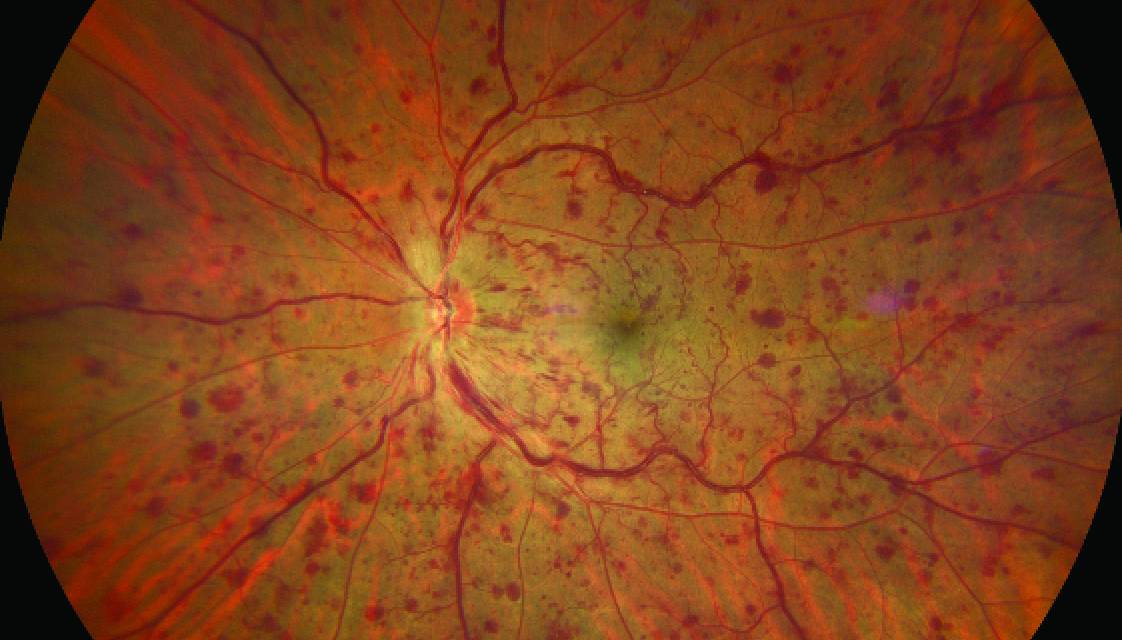 retina image of retinal vein occlusion