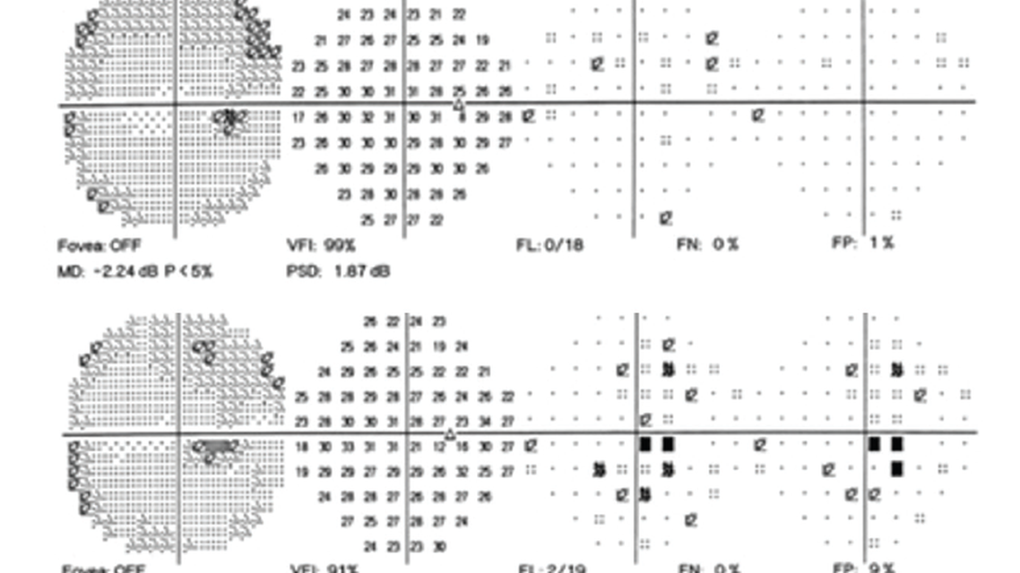Ethambutol Toxic Optic Neuropathy