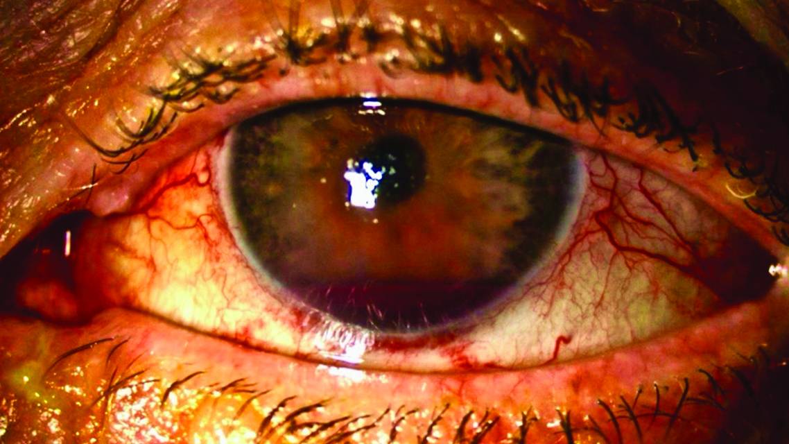 UGH syndrome in an eye anterior segment image