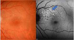 Clinical Case Compendium A Journey Through Detection Treatment Initiation and 2 Years of Active Complement Inhibition