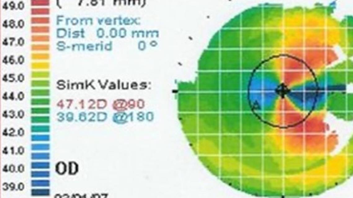 Collaborative Case 012 Best Management of a Visually Significant Cataract and a Nasal Pterygium