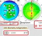 Collaborative Case 010 Managing the Unhappy Presbyopic IOL Patient