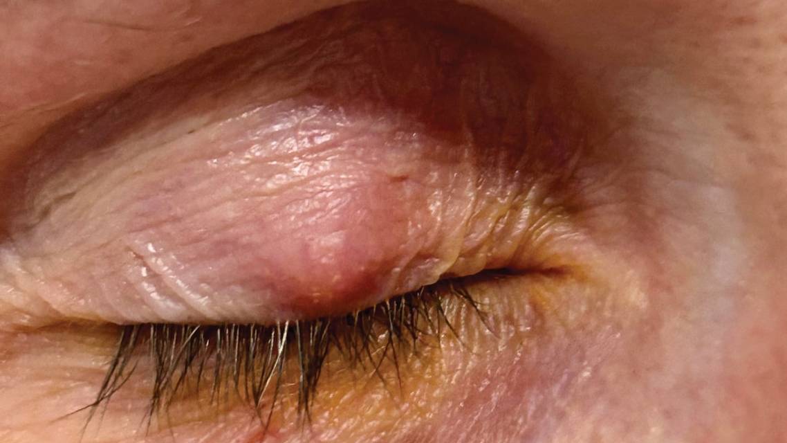 Dont Lump All Lid Lesions Together