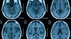 Papilledema Associated With Meningioma