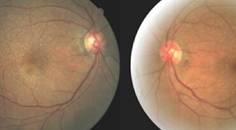 GA Case Compendium  Multimodal Imaging for Following Geographic Atrophy Over Time