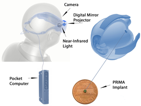 Pixium Vision Announces 48-Month Trial Results in Severe Atrophic AMD image