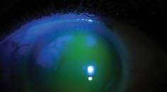 Treating Ocular Surface Disease With Scleral Lenses