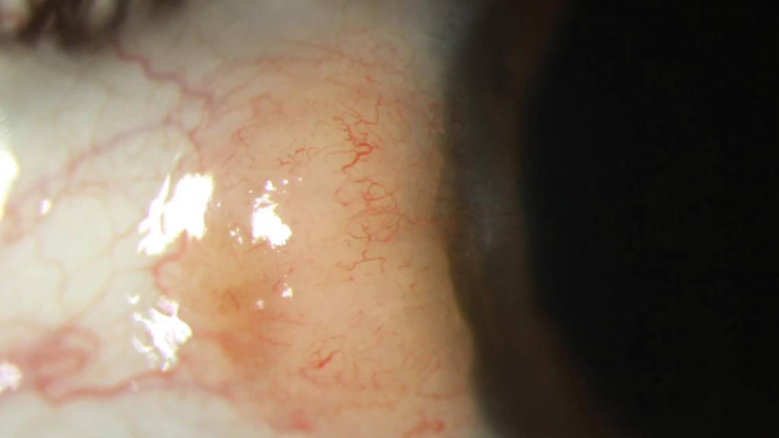 Performing an Optical Biopsy With HR OCT