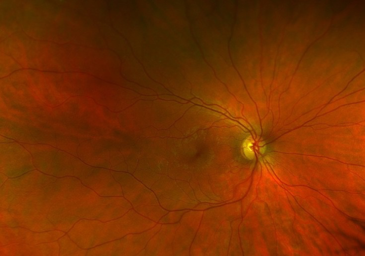 Collaborative Case 005 Things that Bug the Retina