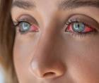 The Role of Inflammation and Immune Response in Dry Eye