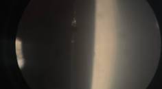cataract