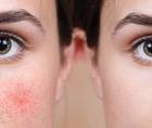 IPL Therapy and Ocular Rosacea