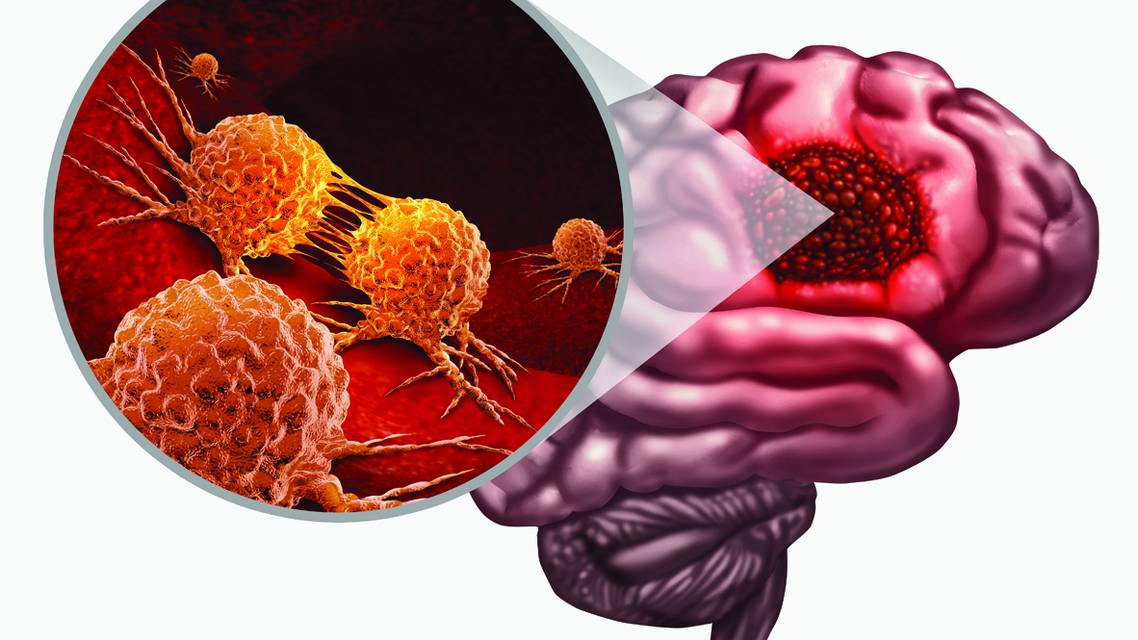 Glioblastoma Multiforme