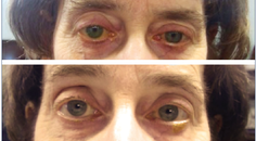 Did I Miss the MIGS Boat