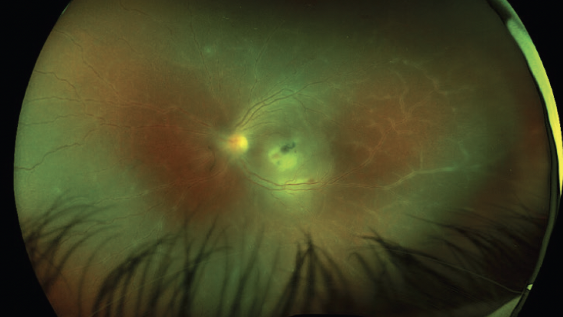 Pacifying a Parasite