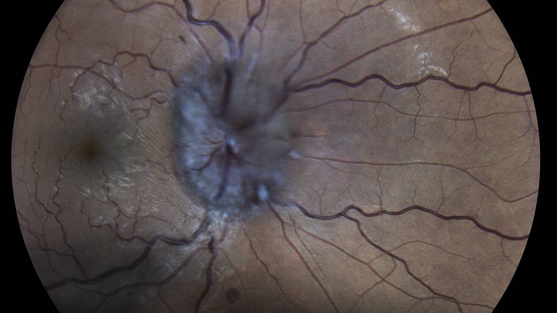 Papilledema
