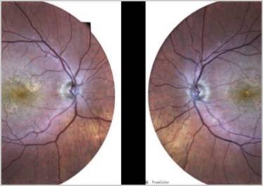 GA Case Compendium The Optometrist as Advocate for the Patient with Geographic Atrophy