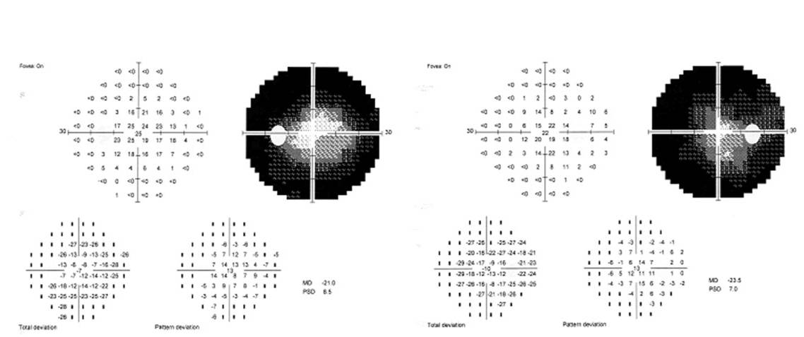Visual fields amblyopia