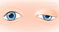 Ocular Ptosis and Its Differential Diagnosis