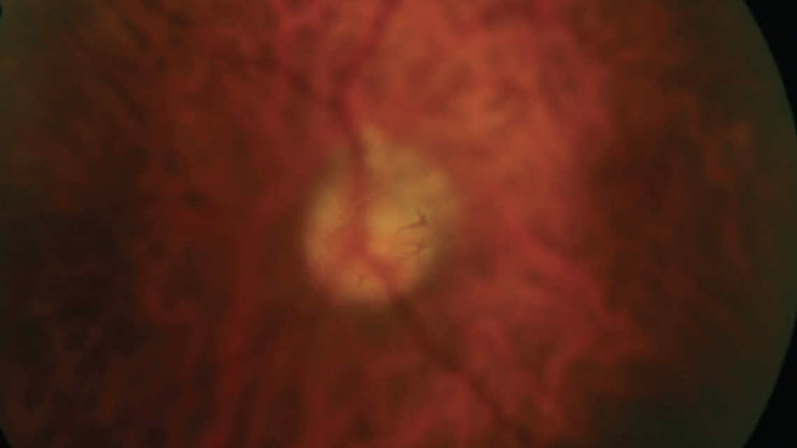 Modern Management Of Vitreous Opacities Acquiring History And Performing A Thorough Clinical Examination