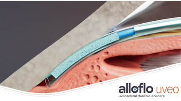 Iantrek Hits 2,000 Procedures for New Bio-Interventional Technology - AlloFlo Uveo image