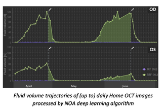 Notal Vision: Clinical Trials Demonstrate Value of Home OCT image