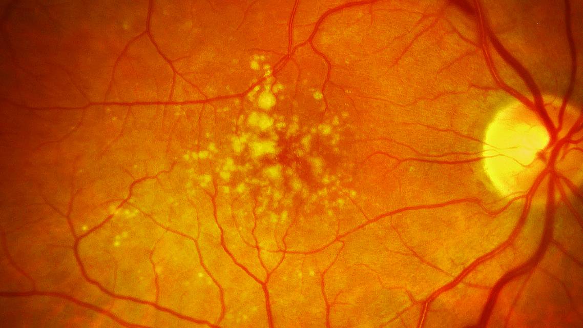 Intermediate AMD Identified Now What