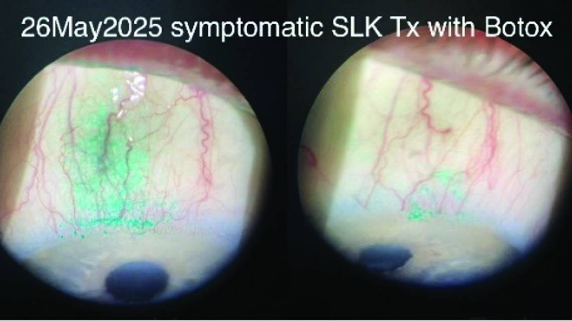 lissamine green staining on the superior bulbar conjunctiva before BTX
