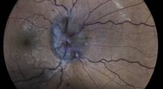 Papilledema