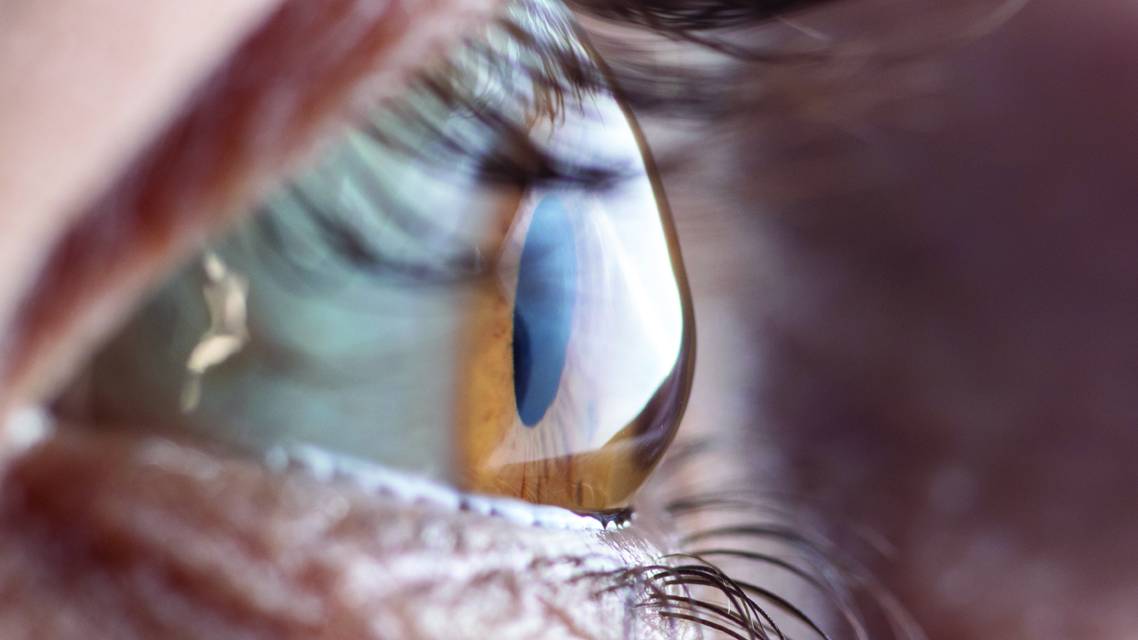 DupilumabAssociated Keratoconjunctivitis