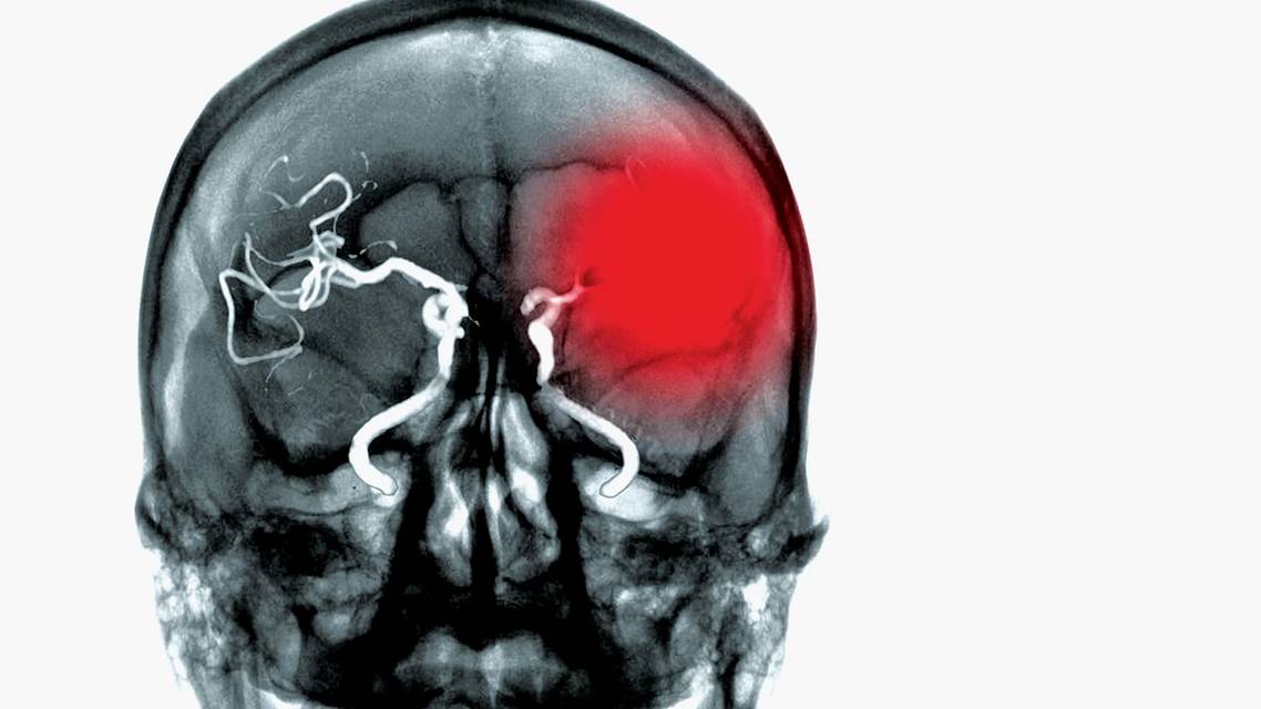 Retinal Artery Occlusion A Sign of Stroke