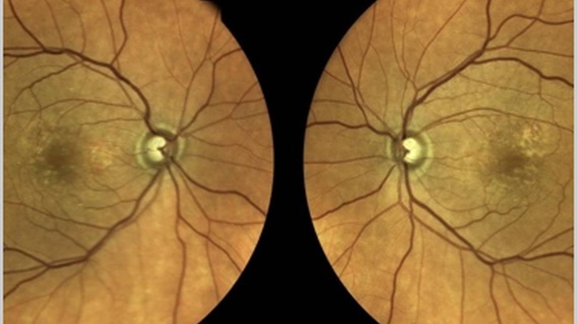 Clinical Case Compendium Setting Expectations and Patient Education in Geographic Atrophy Management